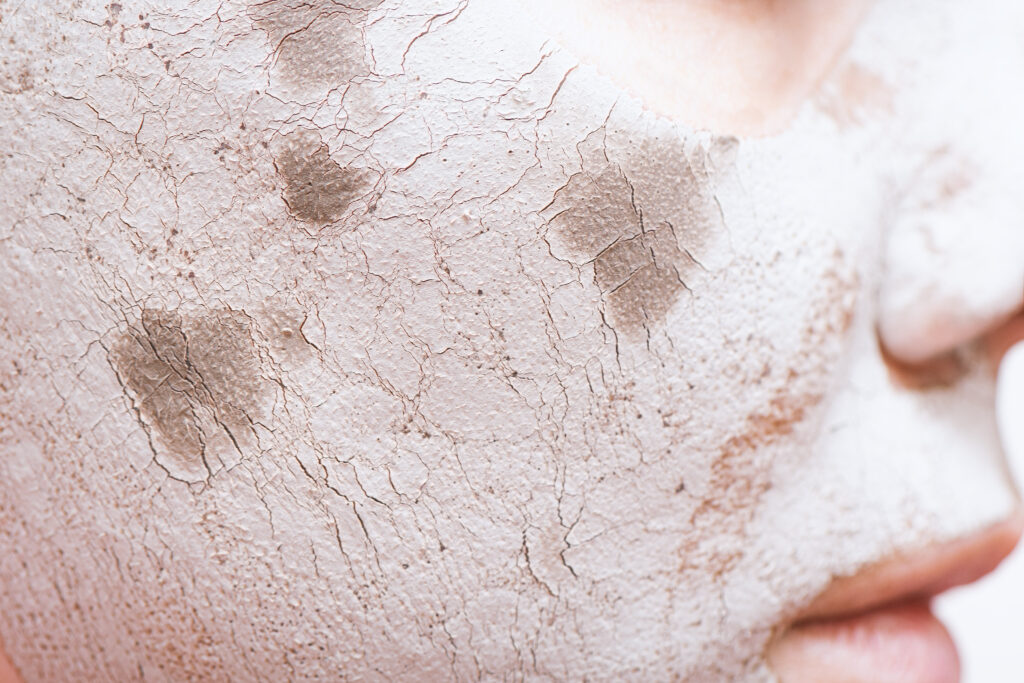 กลไกเอนไซม์ MMPs ย่อยสลายคอลลาเจนทำให้เกิดภาวะ Collagen Turnover ไม่สมดุล